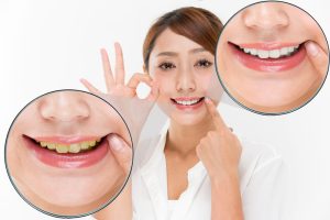 ผู้หญิงกำลังโชว์ผลลัพธ์ของการฟอกสีฟัน