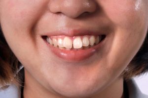 ฟันเหยินเกิดจากปัจจัยจากพันธุกรรมและพฤติกรรมในชีวิตประจำวัน